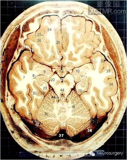 颅脑断层解剖图