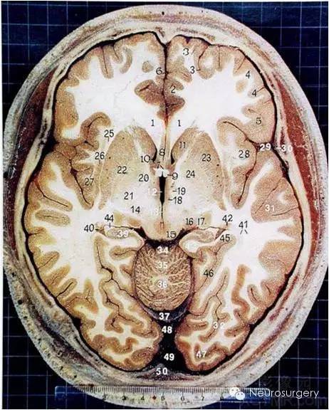 颅脑断层解剖图