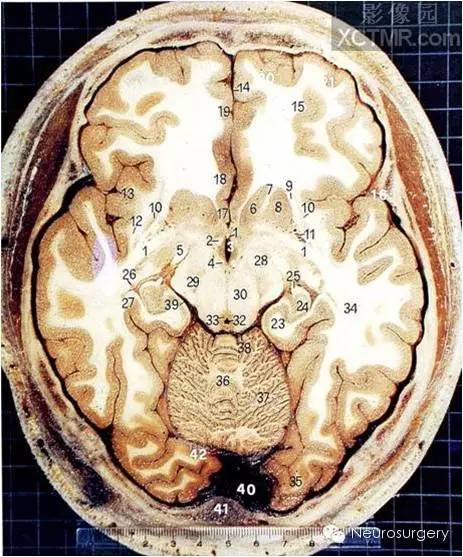 颅脑断层解剖图