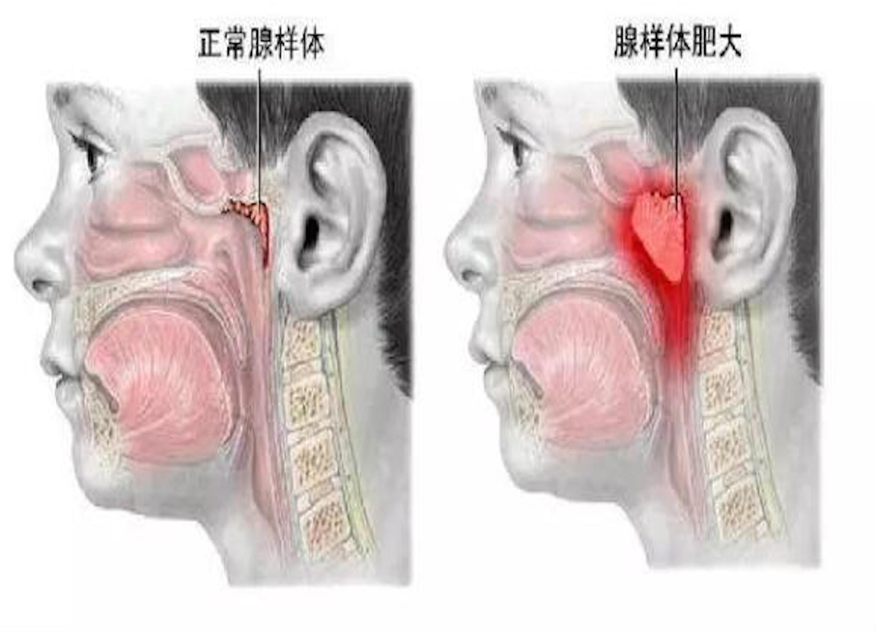 腺样体肥大,严重时可致猝死,教你如何用食物预防及调理孩子的腺样体