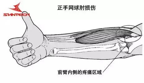 网球肘的形成 ■  症状 :打球几分钟后会感觉手肘内弯与伸直都有痛感