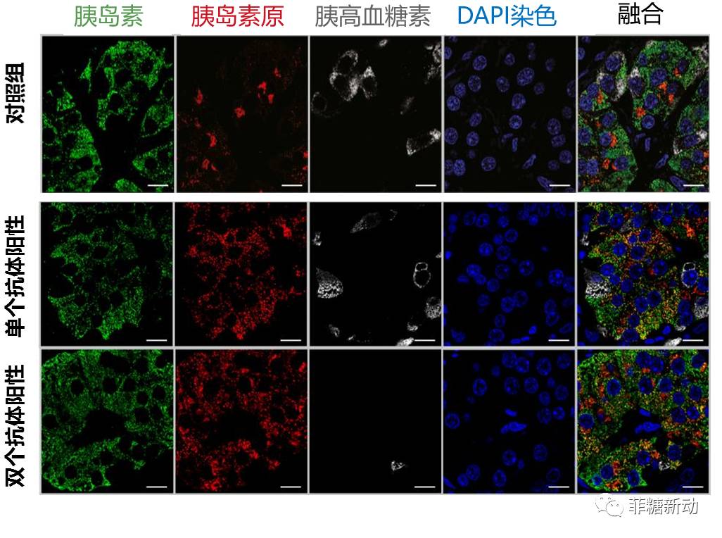 【胰岛β细胞专题】胰岛研究进展之t1dm确诊前胰岛功能研究