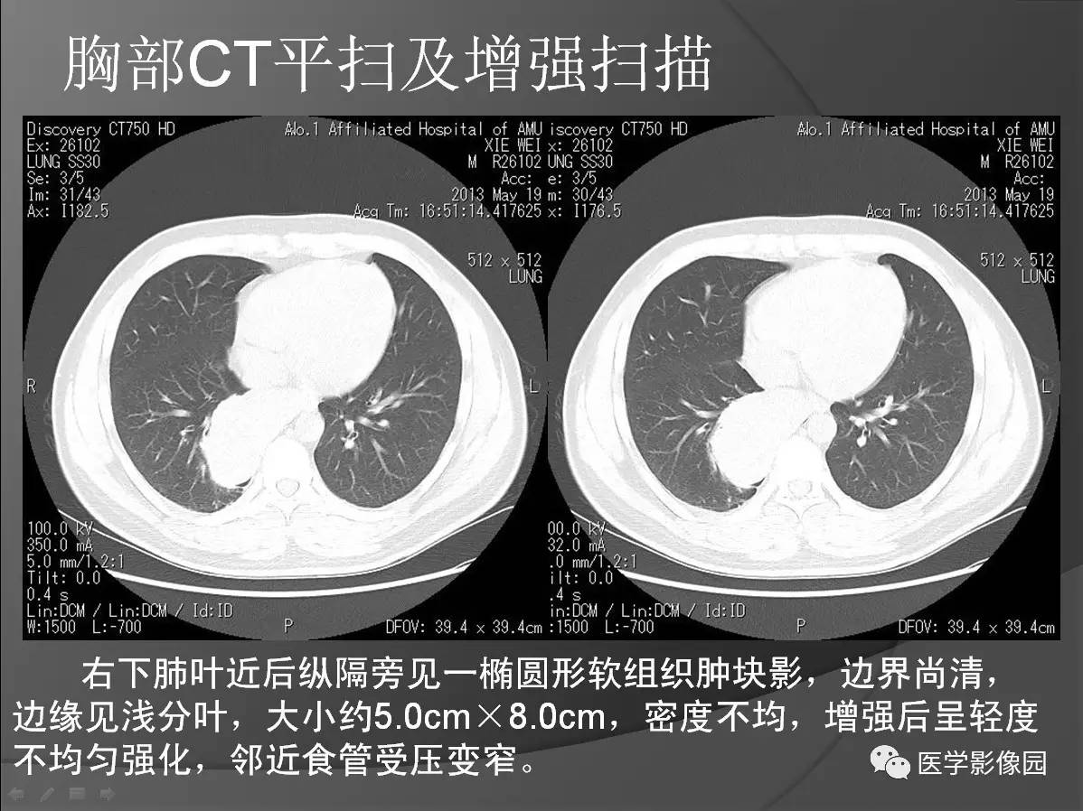 纵隔旁占位等你分析丨读片专栏542期