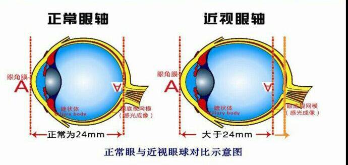 真性近视:眼轴变长,眼在不使用调节时,平行光线进入眼后经过曲折