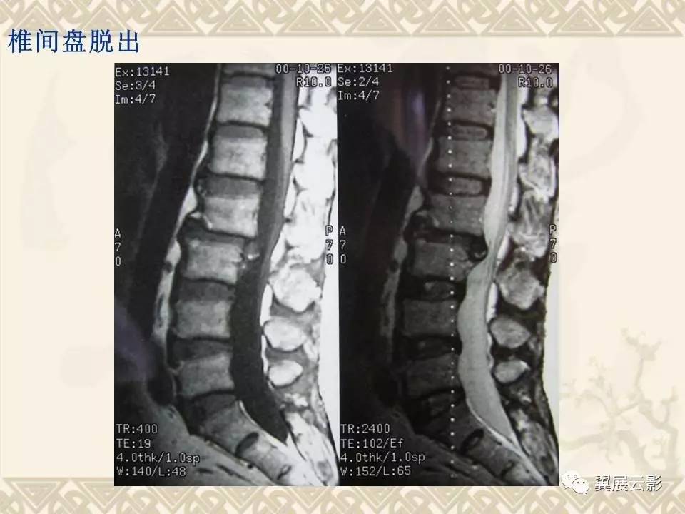 腰椎间盘突出ct的诊断