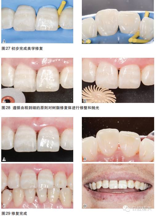 前牙冠折个性化树脂美学直接修复心得与体会