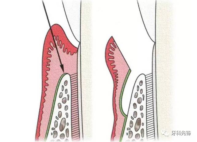 临床牙周病例剖析三种牙龈翻办术的选择及应用