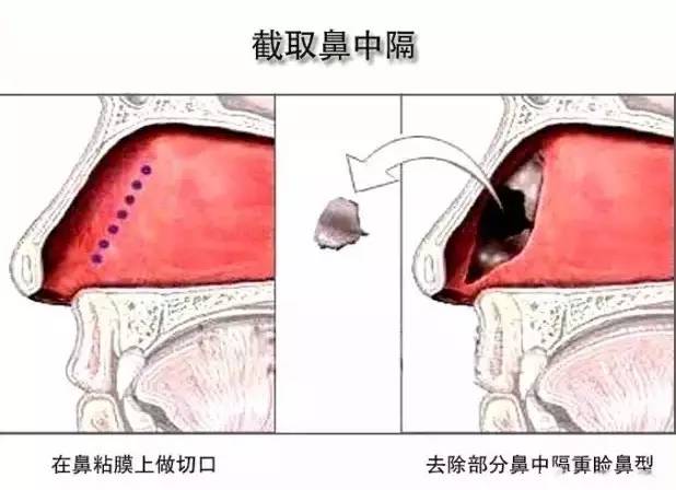 【整外干货】鼻中隔软骨鼻整形术