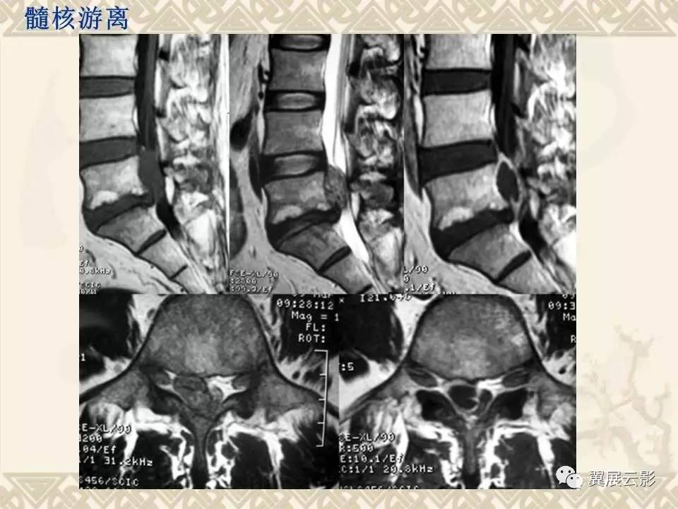 腰椎间盘突出ct的诊断