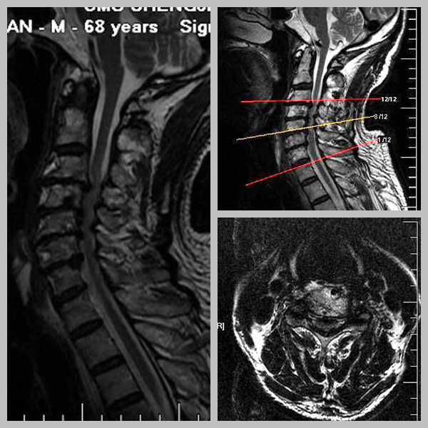 病例:脊髓型颈椎病一例