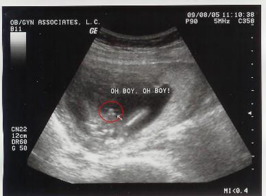 b超图看胎儿性别