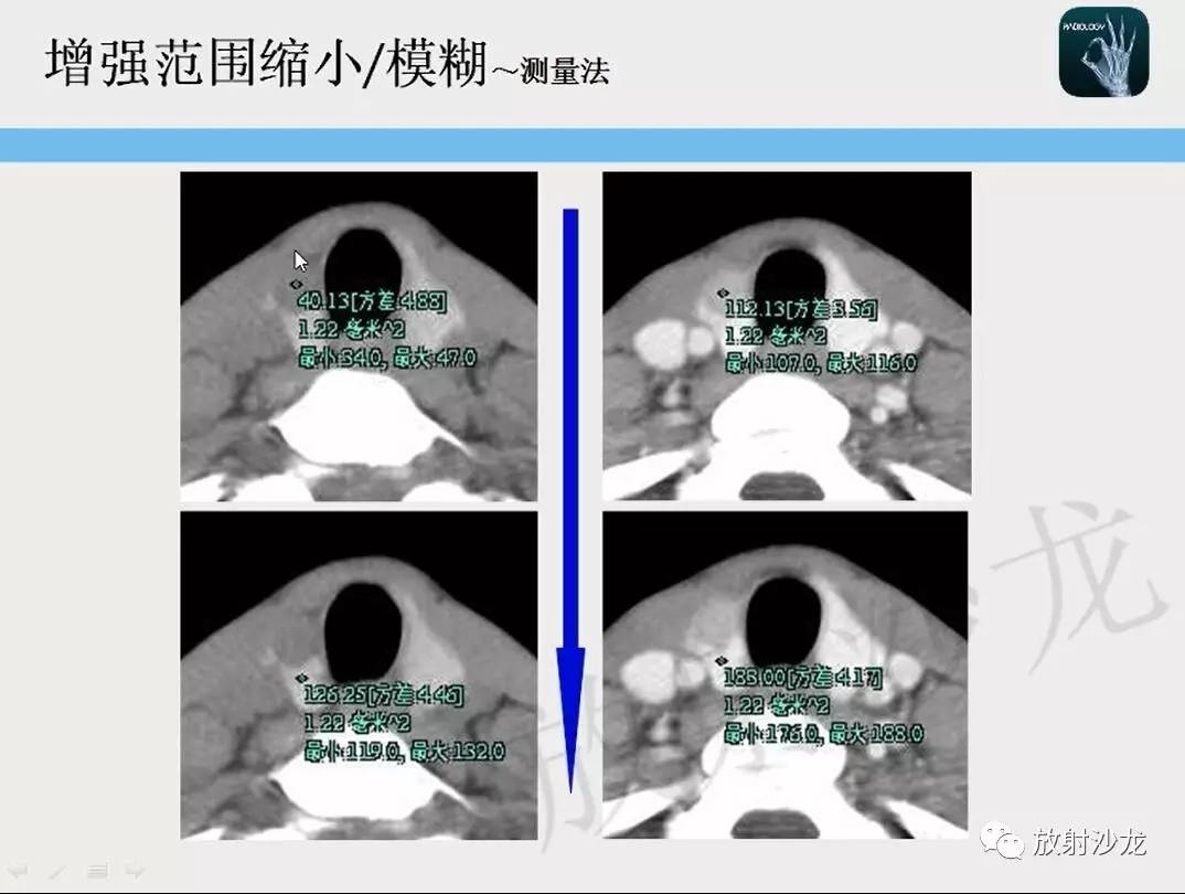 【一眼分辨】甲状腺乳头状癌的ct征象之增强后模糊