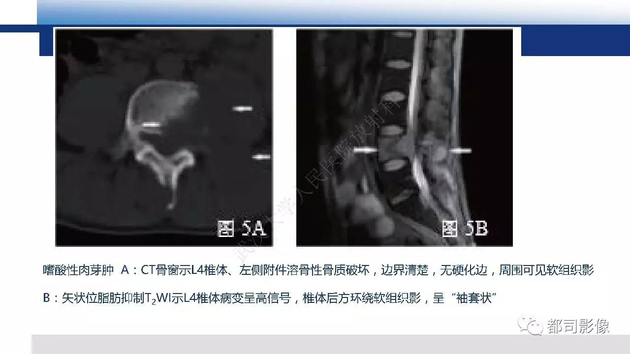 脊柱良性肿瘤及肿瘤样病变影像诊断