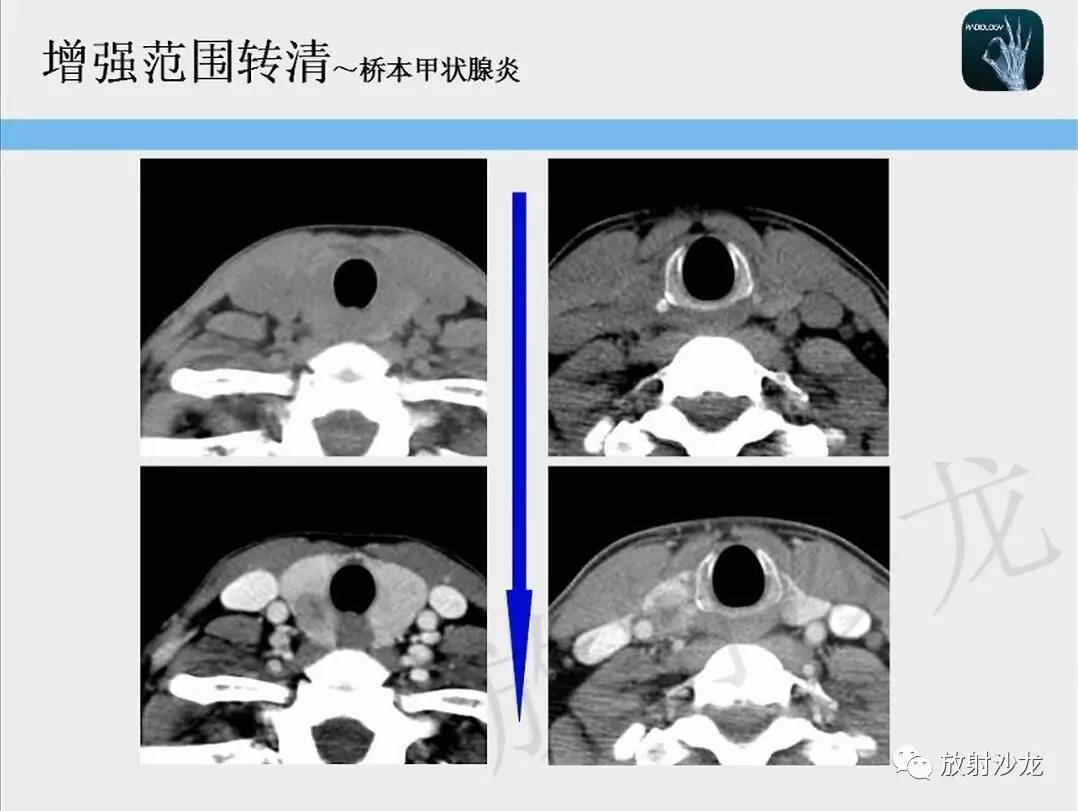 【一眼分辨】甲状腺乳头状癌的ct征象之增强后模糊