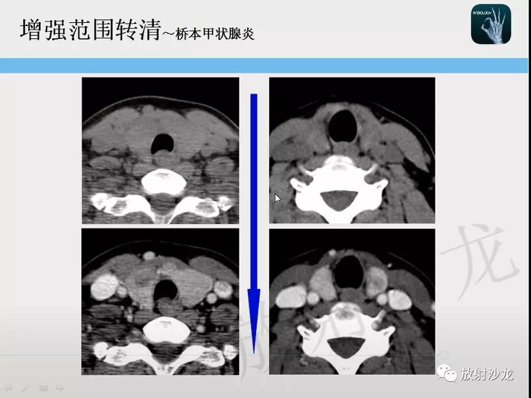 【一眼分辨】甲状腺乳头状癌的ct征象之增强后模糊