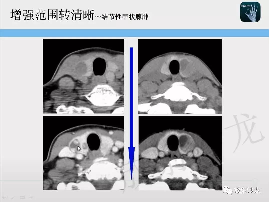 【一眼分辨】甲状腺乳头状癌的ct征象之增强后模糊