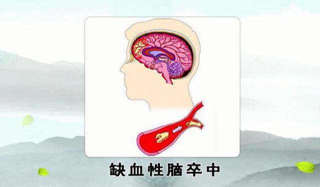 不可忽视的2种常见病竟可导致瘫痪失语要看