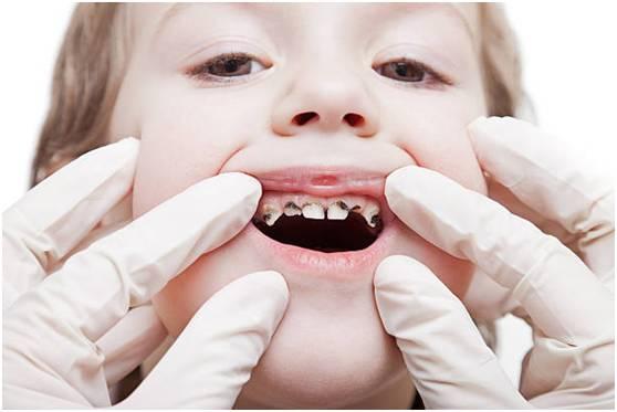 "小烂牙"激增!开学了快看看孩子的牙齿变成啥样了