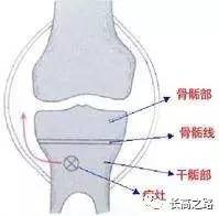 所提出来的 沃尔夫定律,我在《我竟然找到了骨微裂说法的由来》这篇