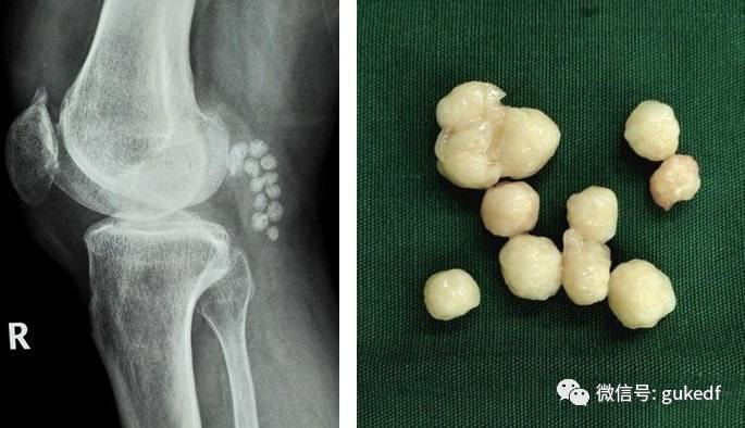 膝关节疼到底是滑膜炎骨质增生还是关节炎