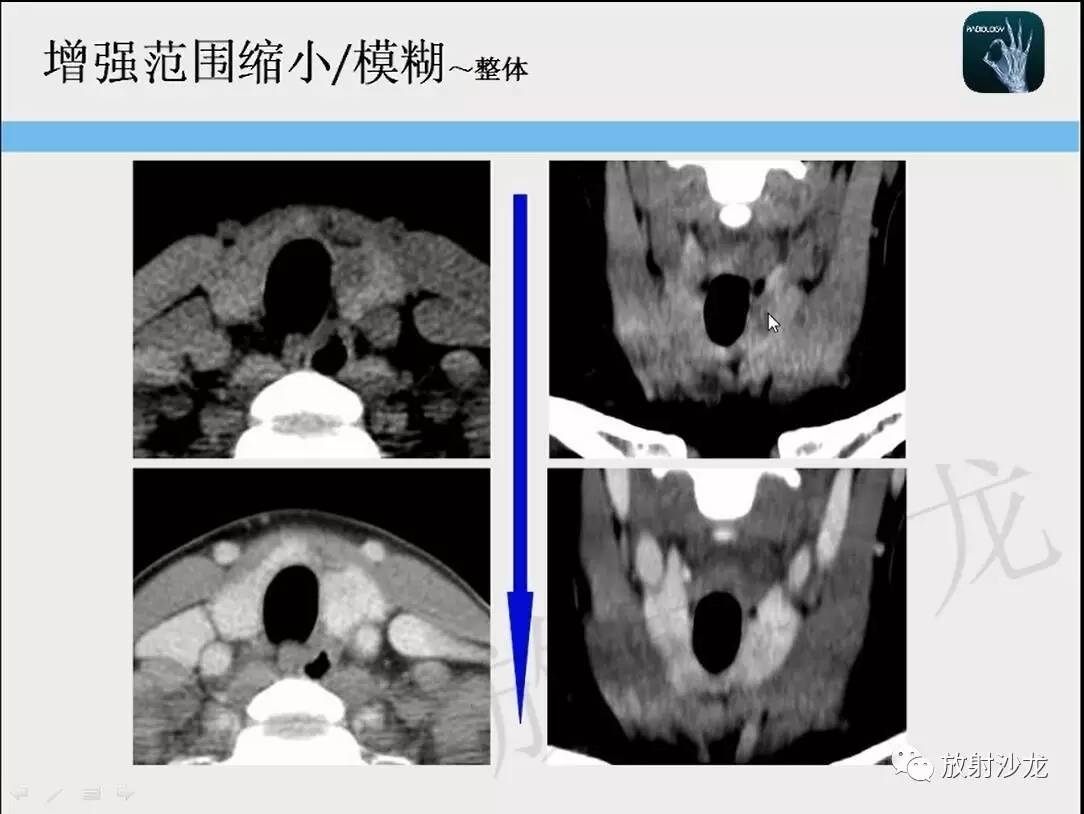 【一眼分辨】甲状腺乳头状癌的ct征象之增强后模糊