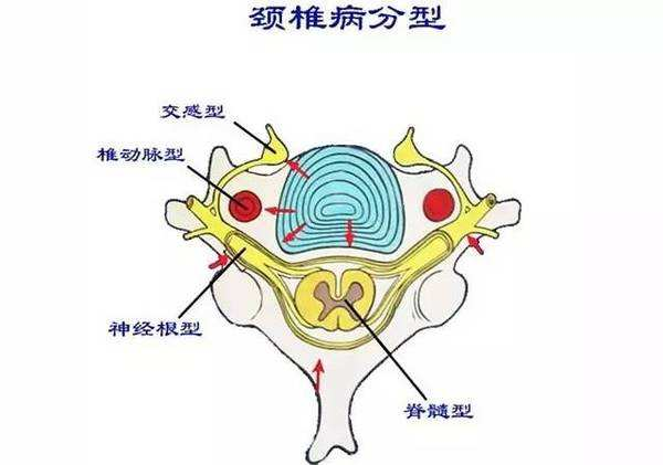 这几个坏习惯绝对是颈椎病的慢性毒药