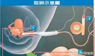 取卵当天,女方应遵医嘱根据麻醉方式禁食禁盐,必要时口福抗生素;注意