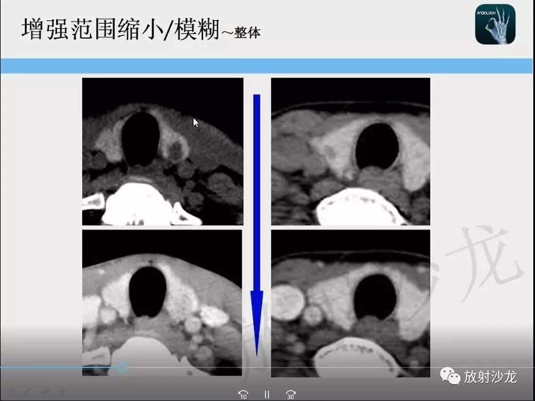 【一眼分辨】甲状腺乳头状癌的ct征象之增强后模糊