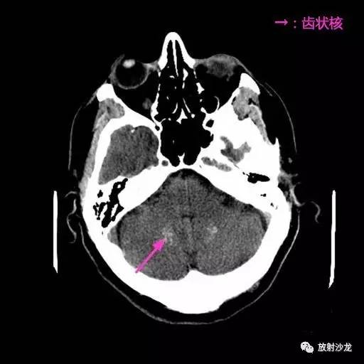 轴位头部ct平扫示双侧对称的高密度钙化灶,累及基底节,丘脑及小脑齿状