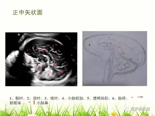 图示手绘读懂正常胎儿颅脑超声