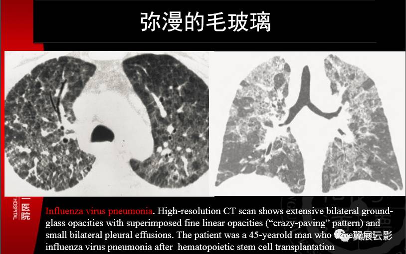 【专家课堂经典回顾】病毒性肺炎