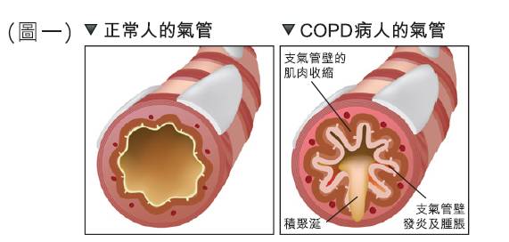 正常人的肺部ct图片