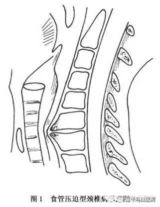 食管压迫型颈椎病