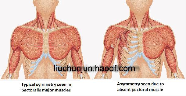 胸大小怎么不一样,会怀疑波兰氏综合 征?