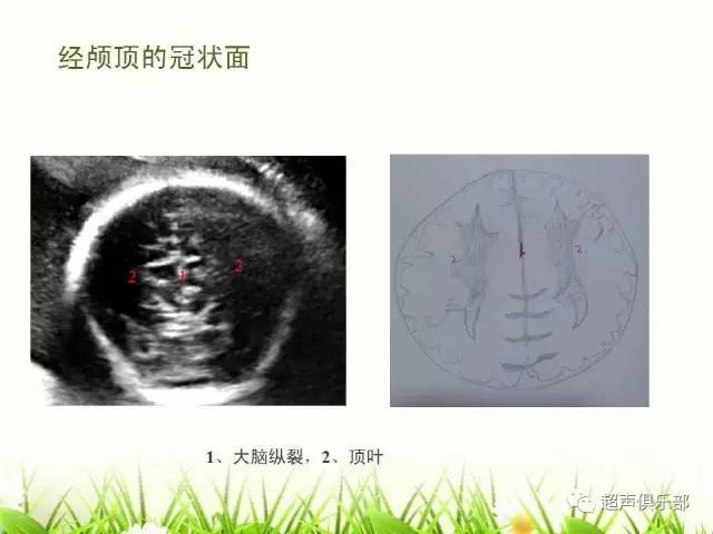 图示手绘读懂正常胎儿颅脑超声