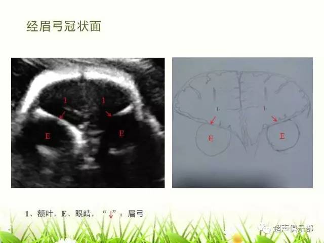 图示手绘读懂正常胎儿颅脑超声