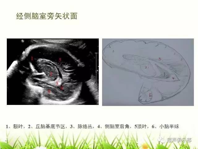 图示手绘读懂正常胎儿颅脑超声