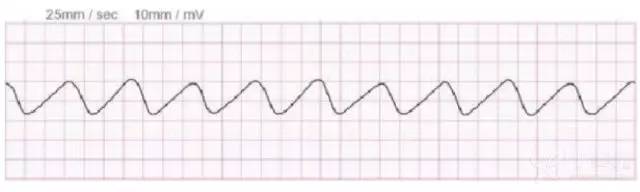 (2)qrs-t 波融合,形成典型的高血钾正弦波形(1)心电图表现3.