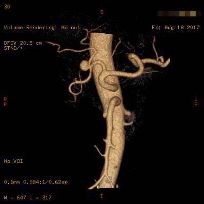 病例| 容易漏诊的肝动脉瘤