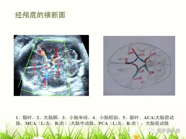 图示手绘读懂正常胎儿颅脑超声