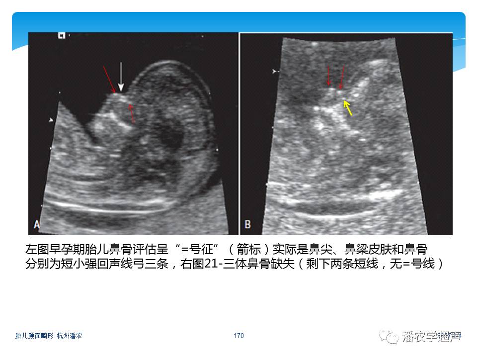 【超声微课堂】胎儿颜面部畸形超声诊断思路:胎儿鼻异常