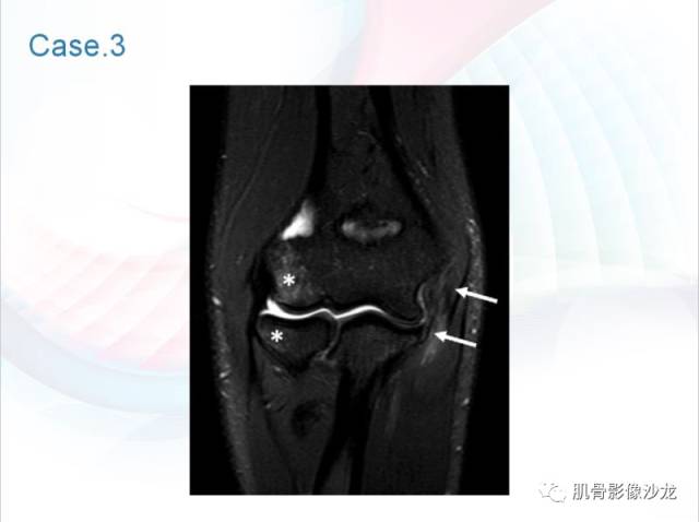 肘关节运动损伤的影像诊断