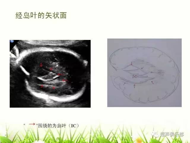 图示手绘读懂正常胎儿颅脑超声