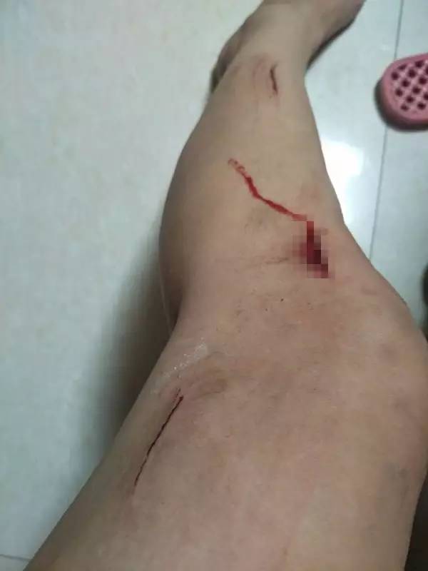 缝了四针 除了小腿上深深的伤口外 还有几处不同程度的划伤
