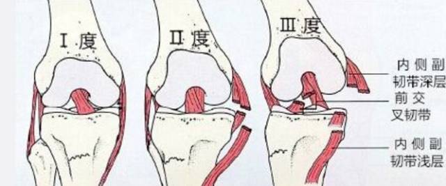 膝盖是不稳定的,外面的一圈韧带及里面的"软垫"半月板,保障了关节的