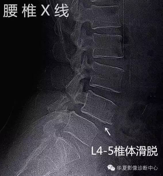 腰椎滑脱分度,且看高清图解