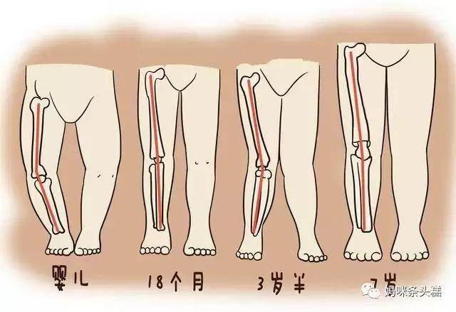 关注孩子腿型发育宝宝的青蛙腿需要及时纠正吗