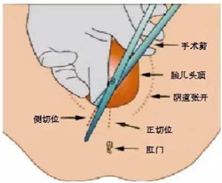 侧切,常伴有会阴撕裂