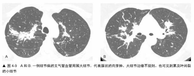有些肺区可见成簇的肉芽肿,而其他区表现正常(图4-8)