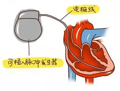 心脏起搏器通常埋植在上胸部的皮下,导线经由静脉到达心脏,它是由脉冲